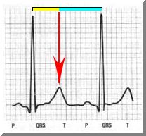 heartbeat2.jpg